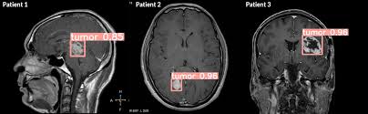 Brain Tumor Detection Using Deep Learning